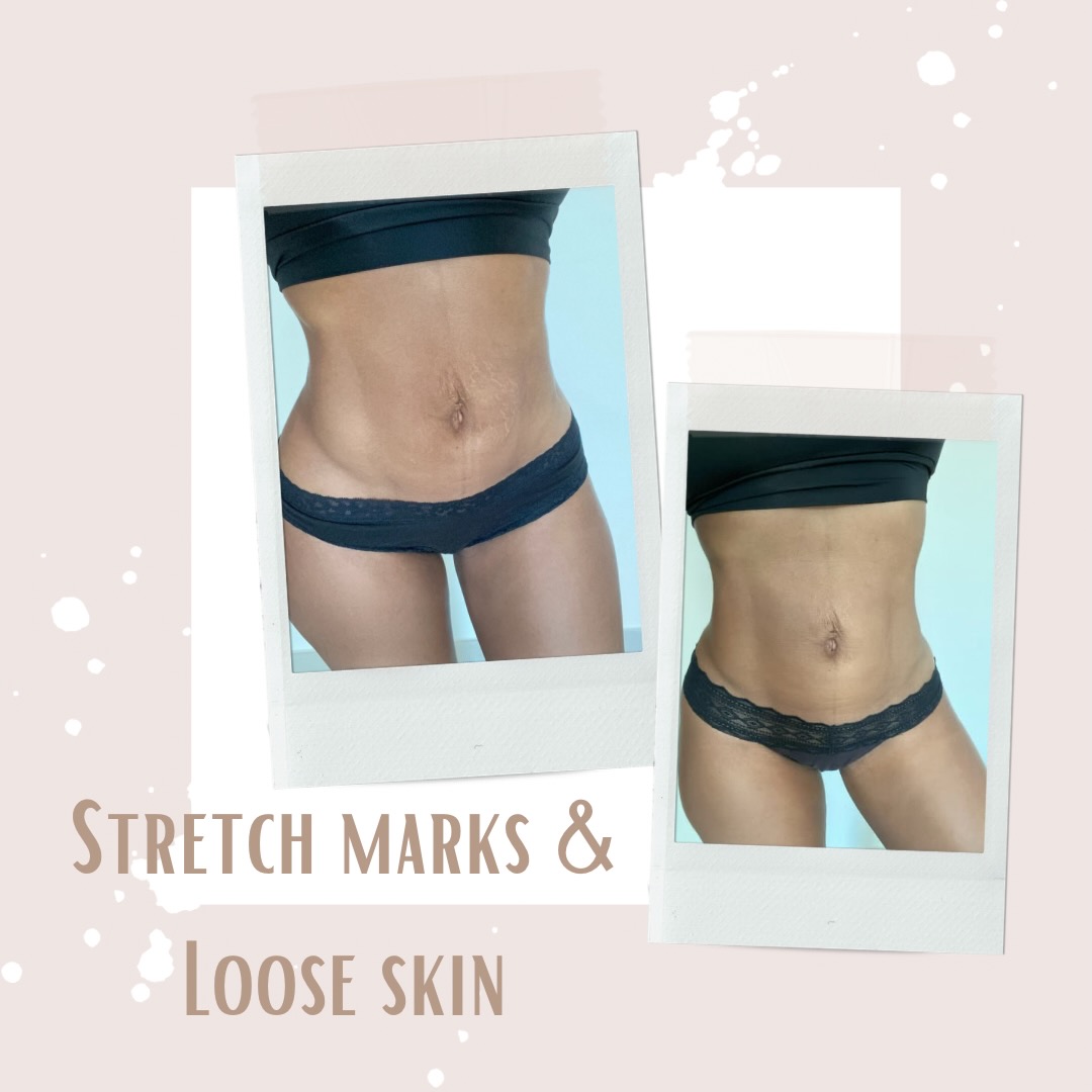Stretchmarks and Loose Skin